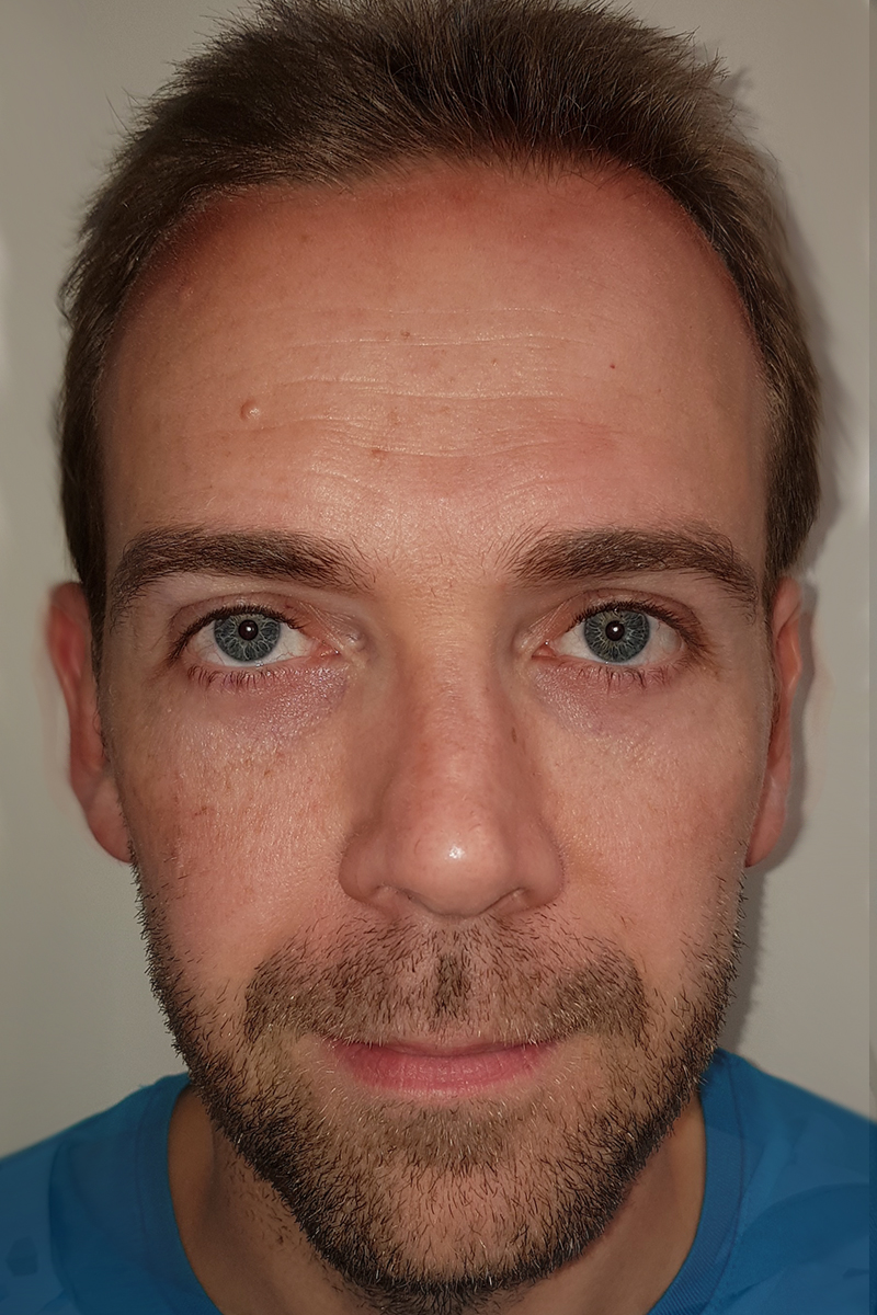 Before & After — after (post-operative)
