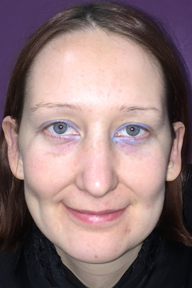 Before & After — after (post-operative)