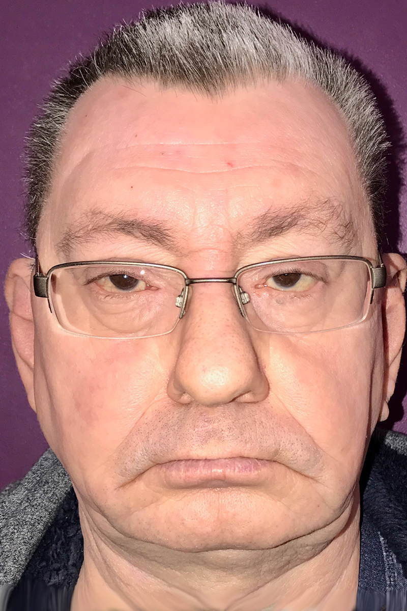 Before & After — after (post-operative)