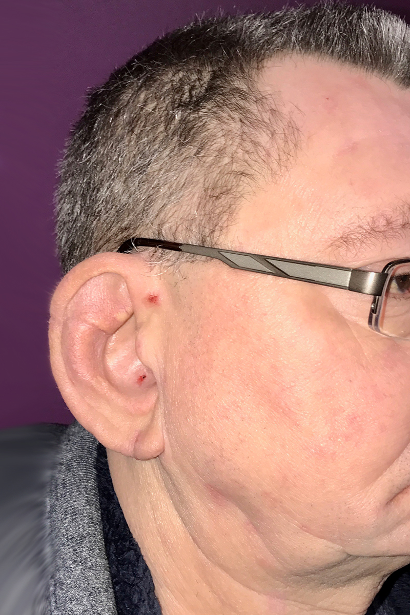 Before & After — after (post-operative)