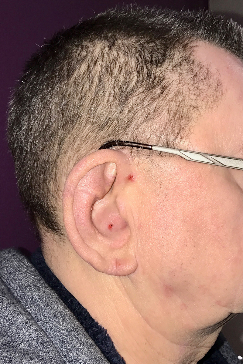 Before & After — after (post-operative)