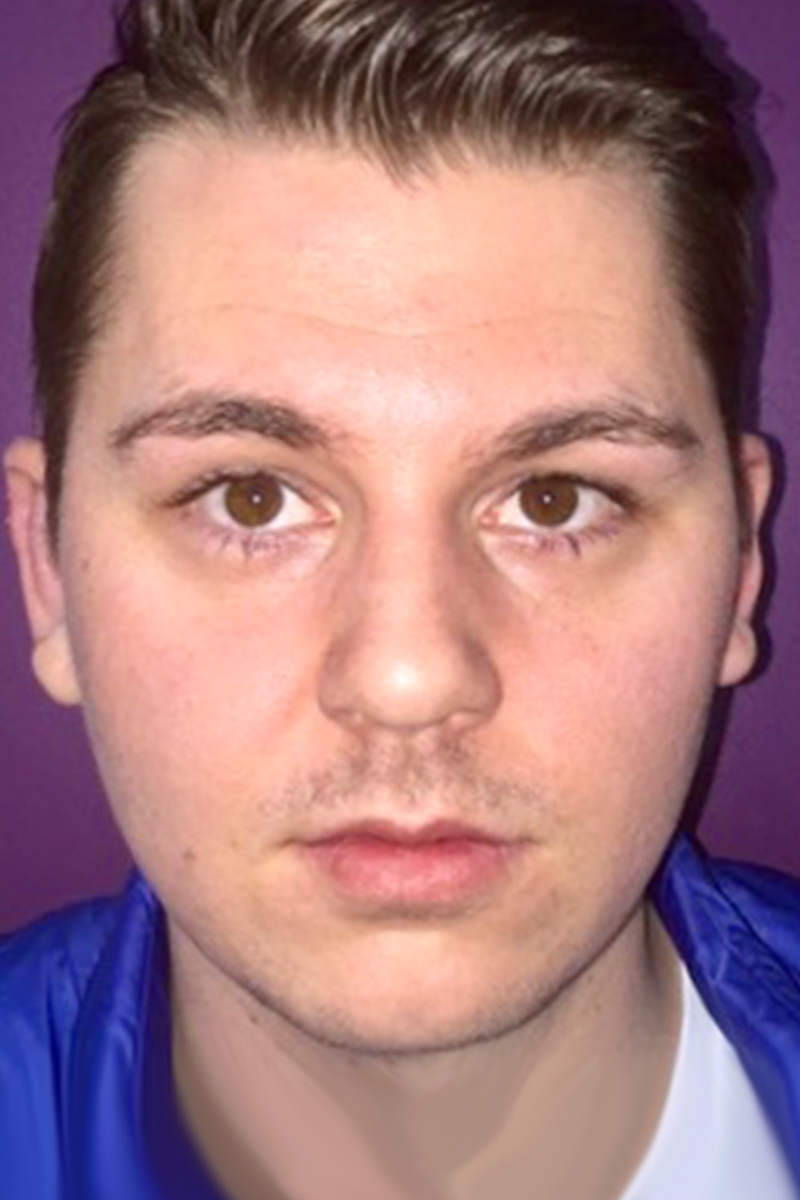 Before & After — after (post-operative)