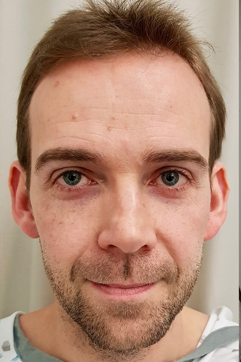 Before & After — before (pre-operative)