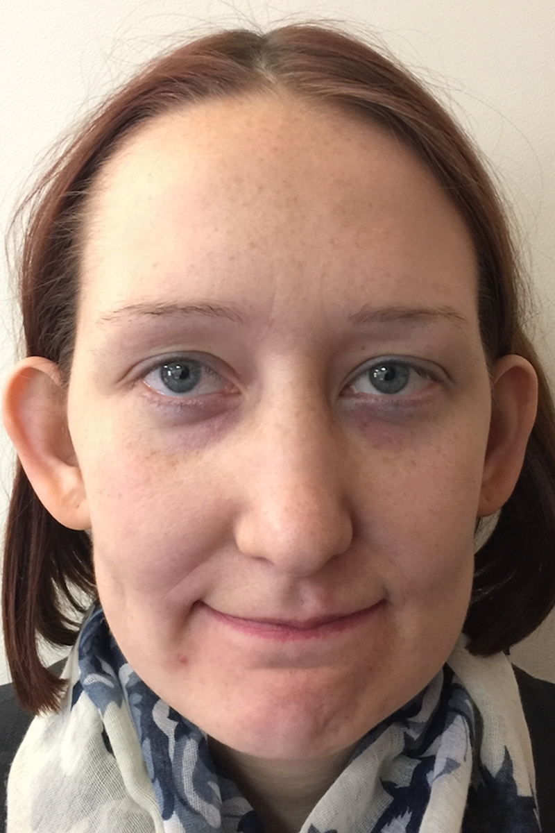 Before & After — before (pre-operative)
