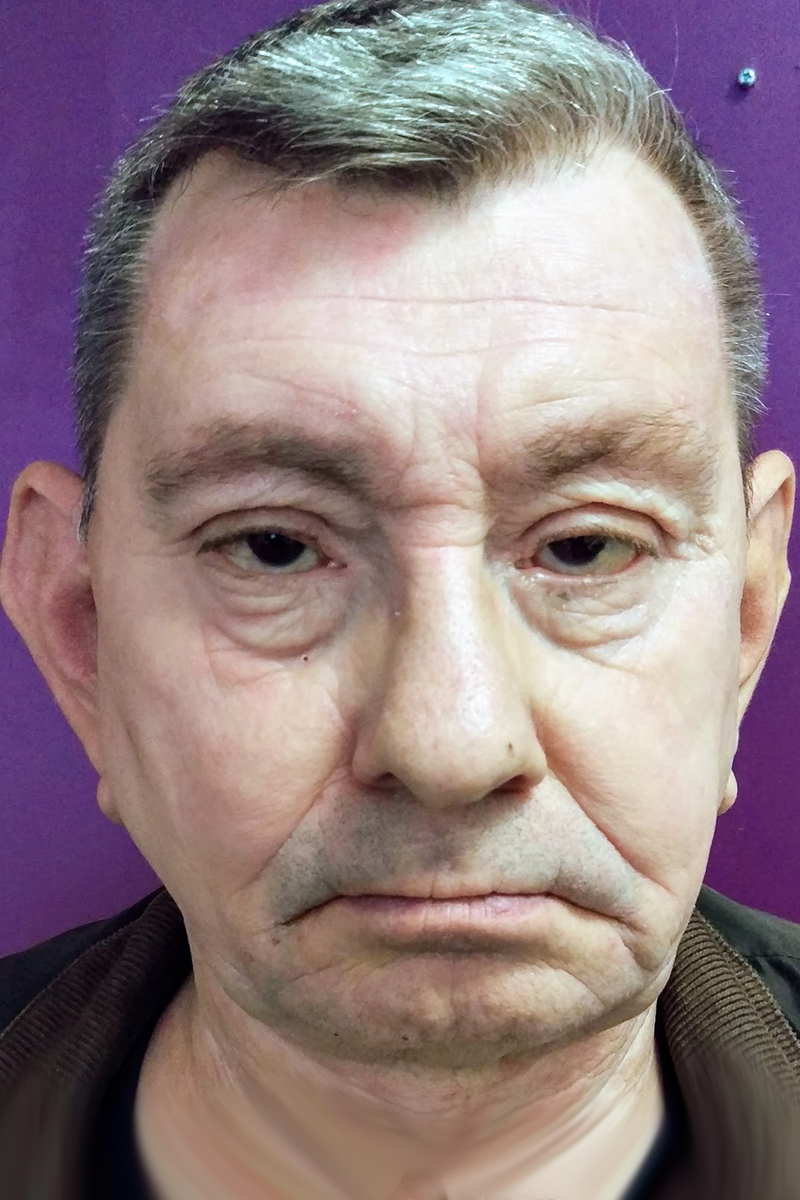 Before & After — before (pre-operative)