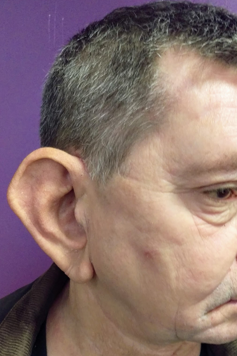 Before & After — before (pre-operative)