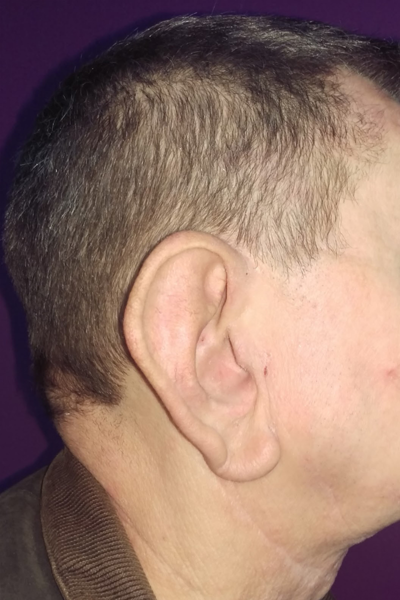 Before & After — before (pre-operative)