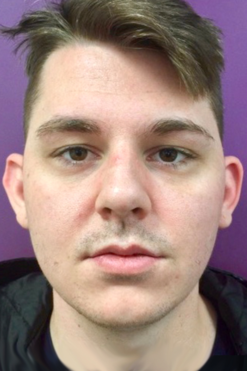 Before & After — before (pre-operative)