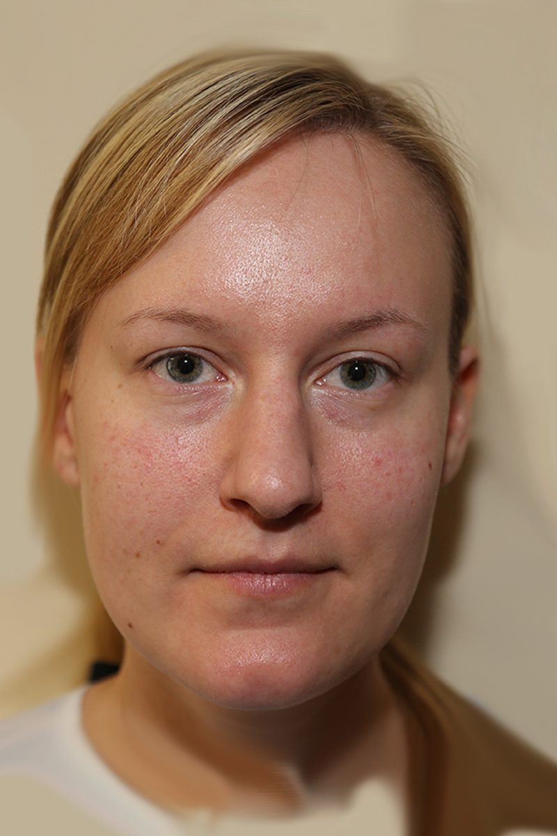 View 1 — before (pre-operative)