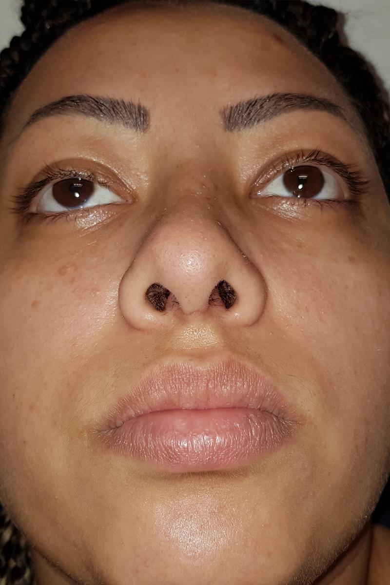 View 1 — after (post-operative)