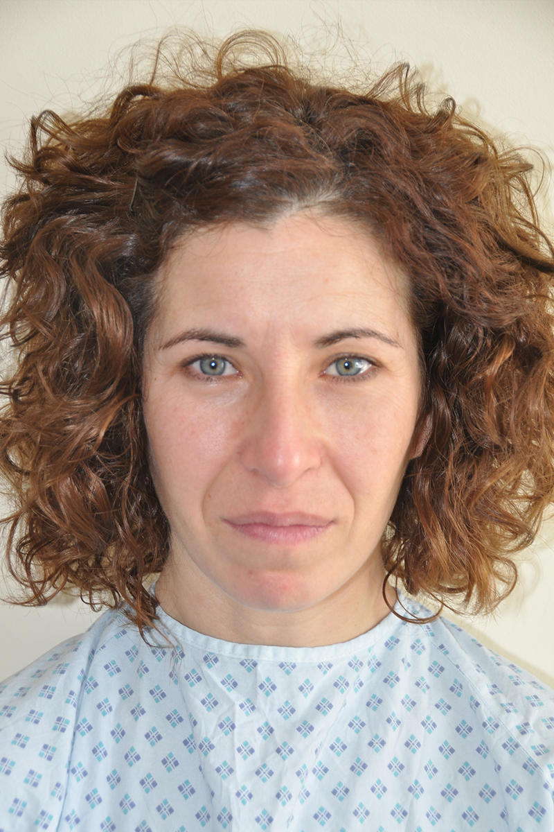 View 1 — before (pre-operative)