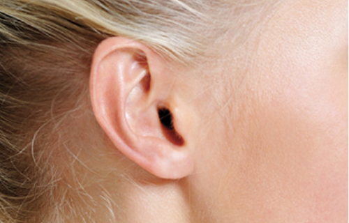 Otoplasty patient gallery category